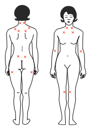 fibromyalgie symptomen